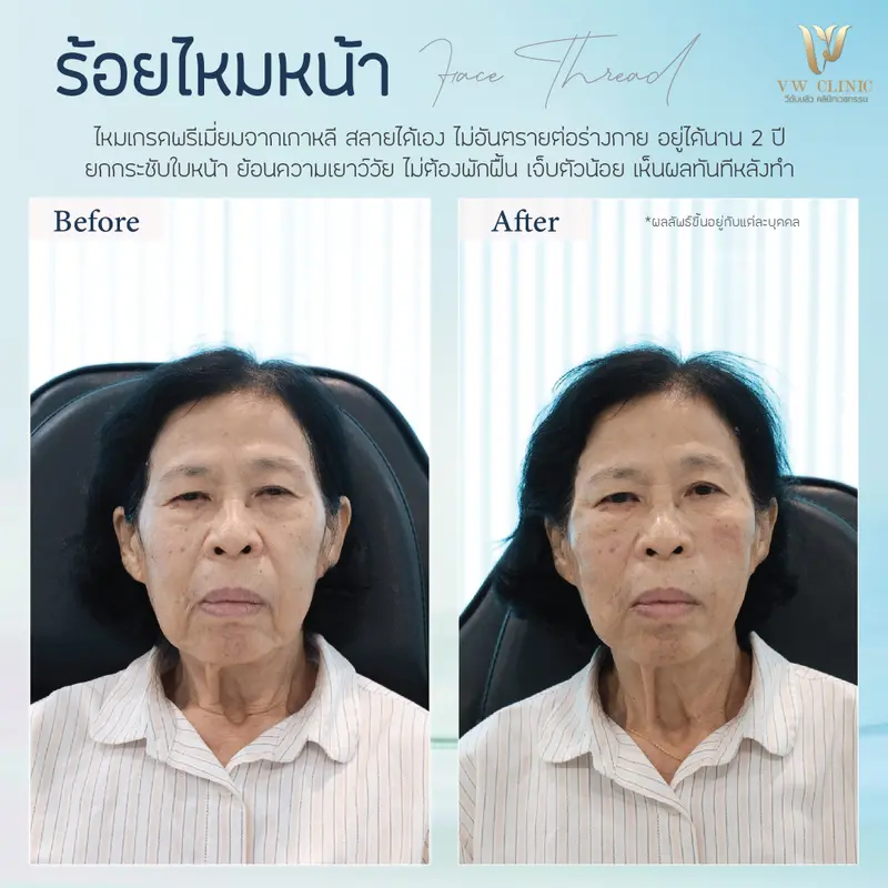 ร้อยไหมหน้า 6 เส้น