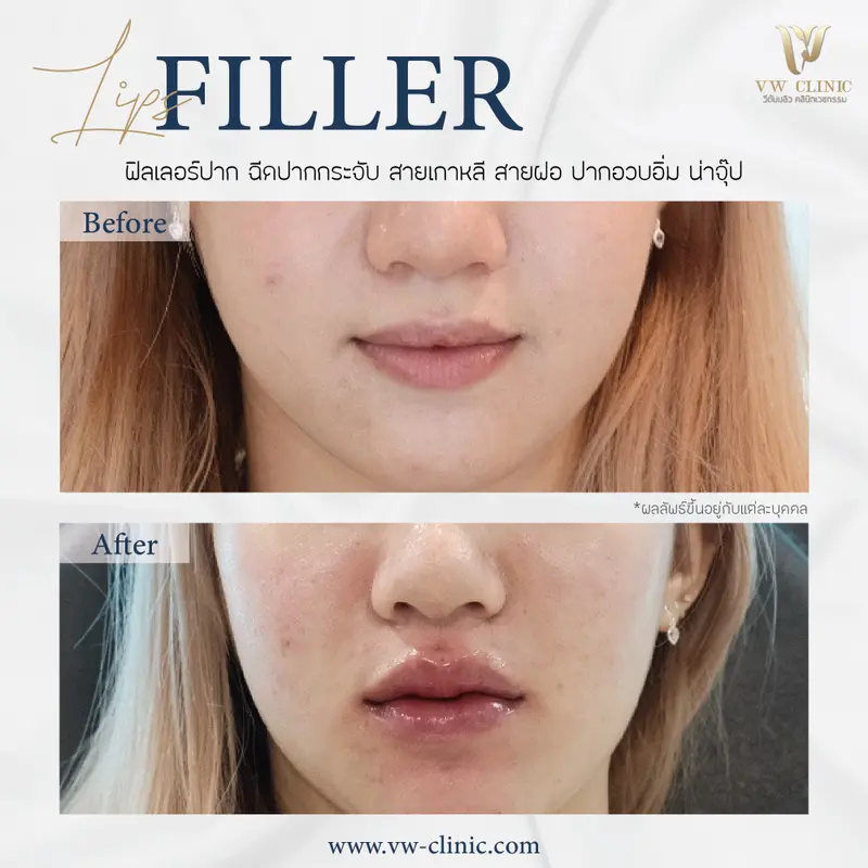 Filler ปาก