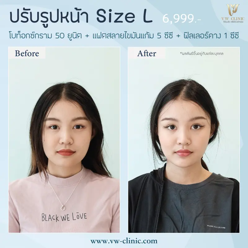 Botox กราม + Fat แก้ม + Filler คาง