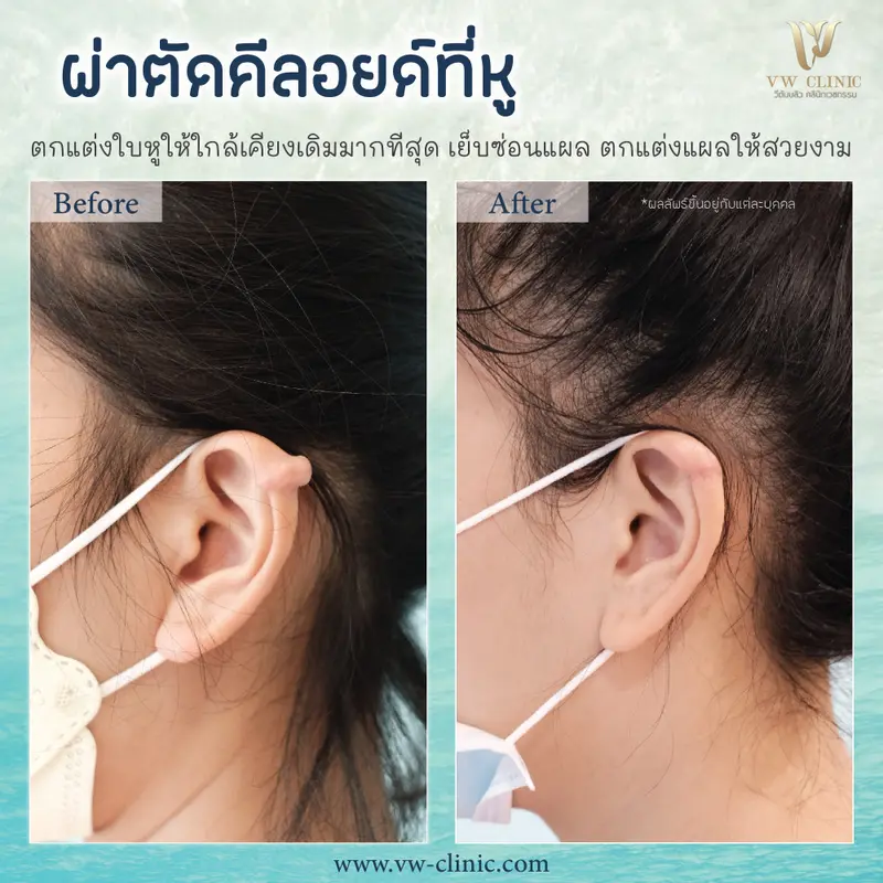 ผ่าตัดคีลอยด์หู