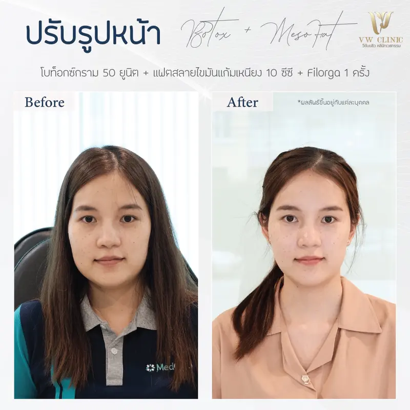 Botox กราม + Fat 10 cc + Filorga 1 ครั้ง