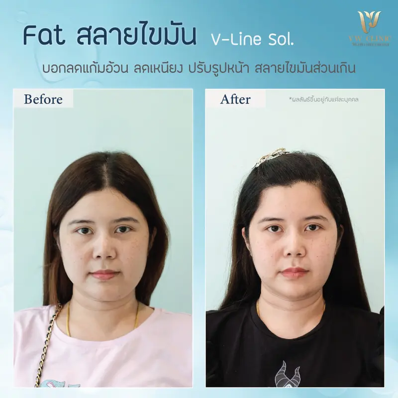 Fat สลายแก้ม