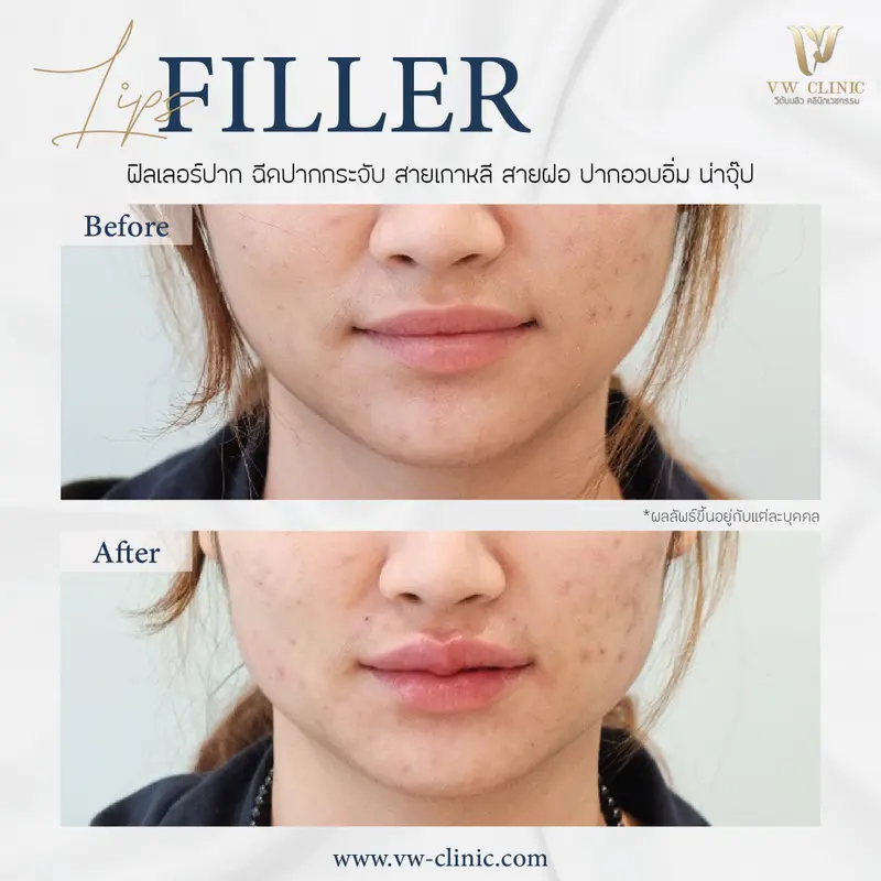 Filler ปาก
