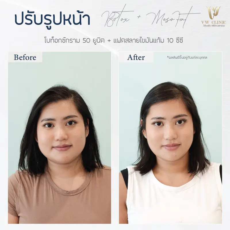 ฺBotox กราม + Fat 10 cc แก้ม