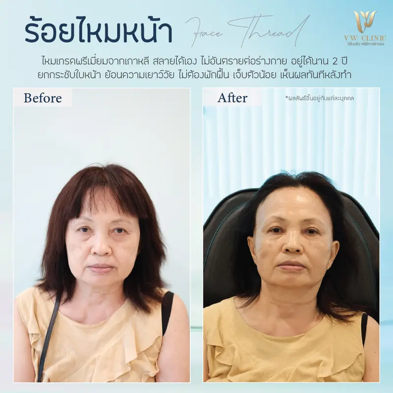 ร้อยไหมหน้า 6 เส้น