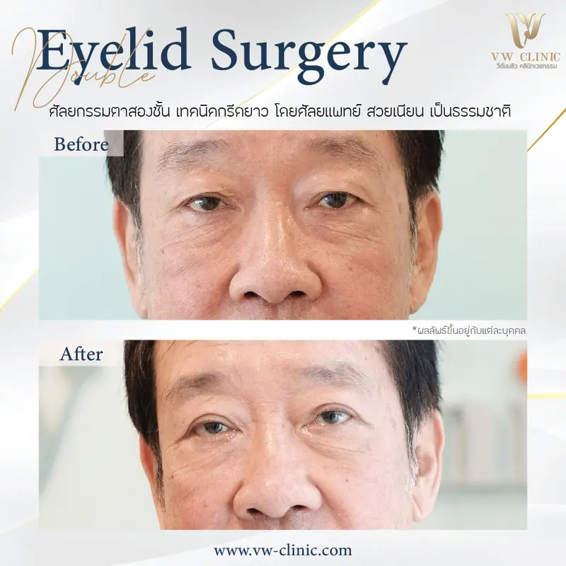 ผ่าตัดตาสองชั้น