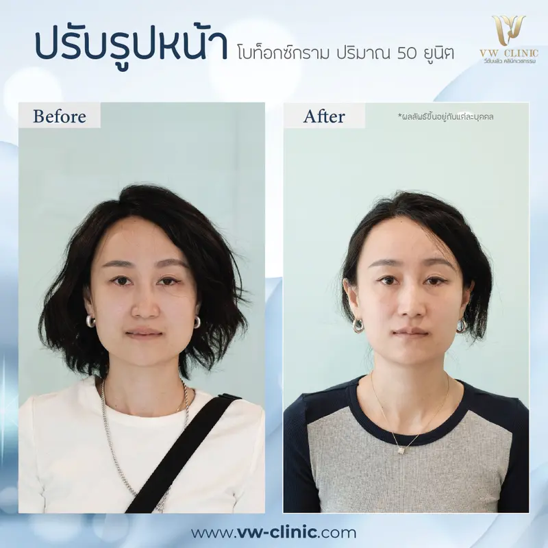 Botox กราม 50 unit