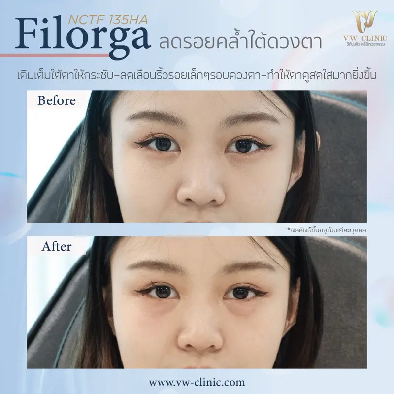 ลดรอยคล้ำใต้ตา