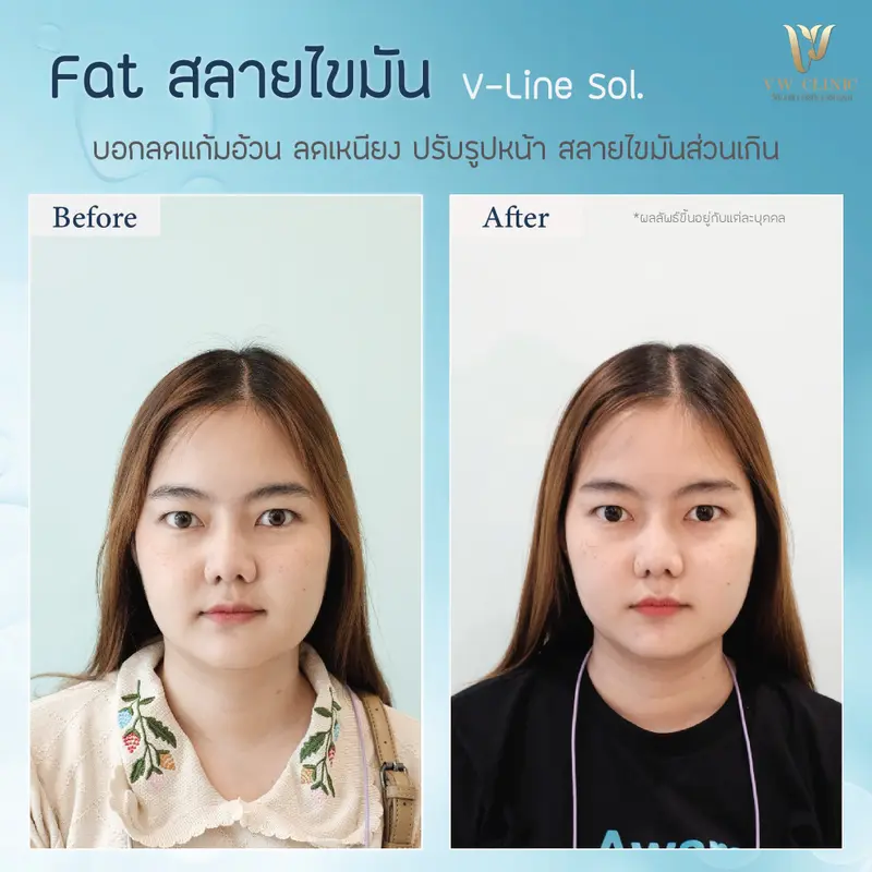 สลายไขมัน