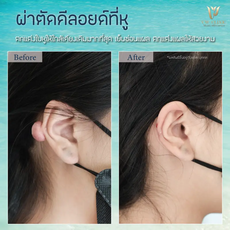 ผ่าตัดคีลอยด์หู