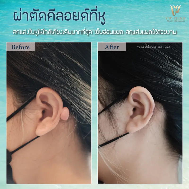ผ่าตัดคีลอยด์หู
