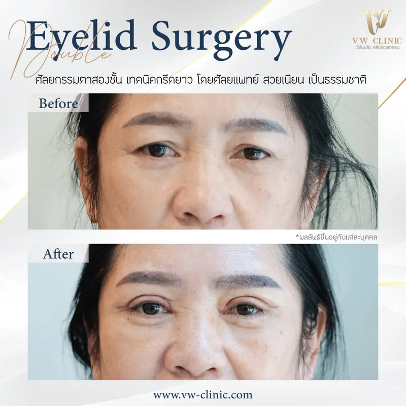 ผ่าตัดตาสองชั้น