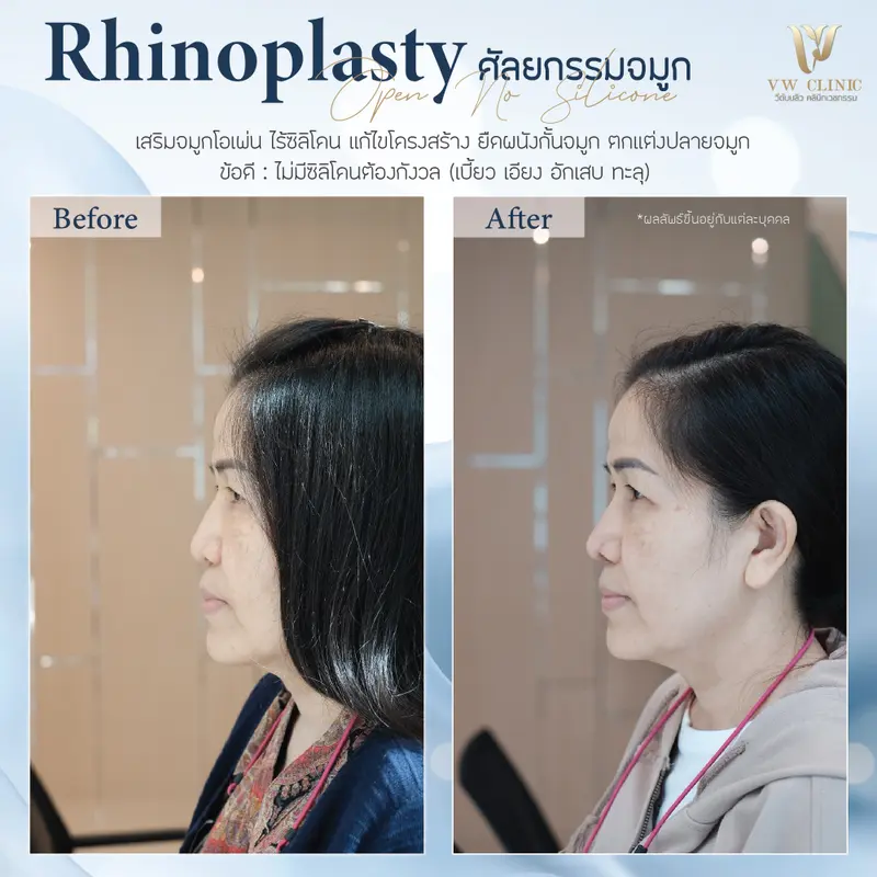 เสริมจมูกไร้ซิลิโคน (เคสแก้)