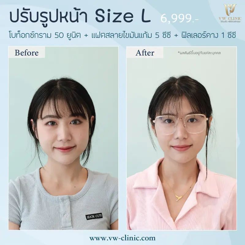 Botox กราม + Fat แก้ม + Filler คาง