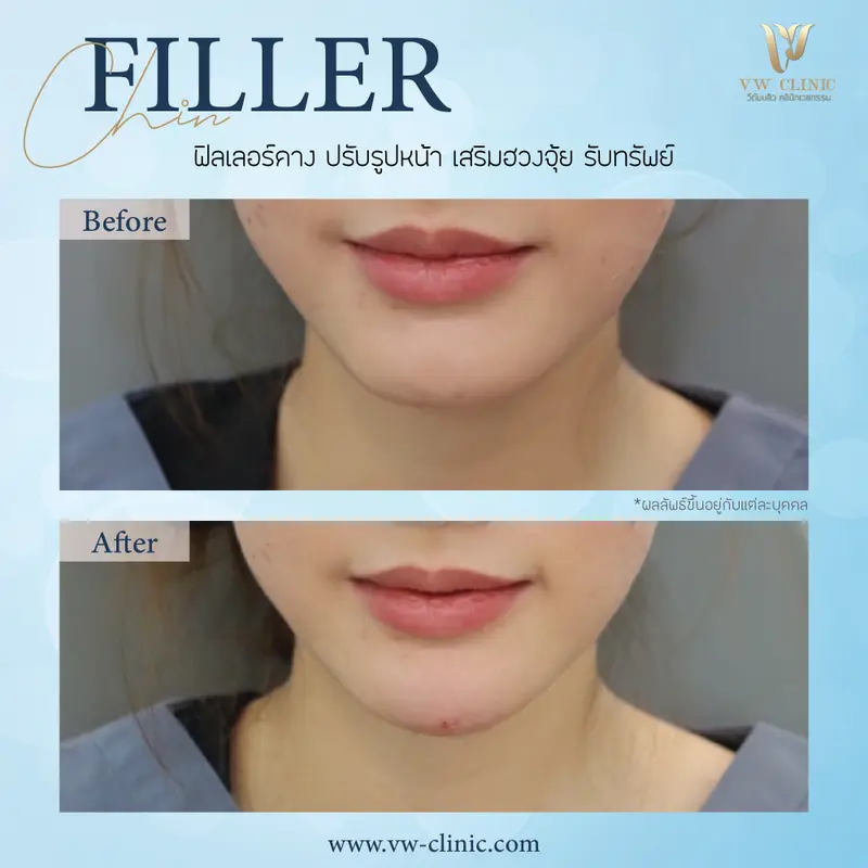 Filler คาง