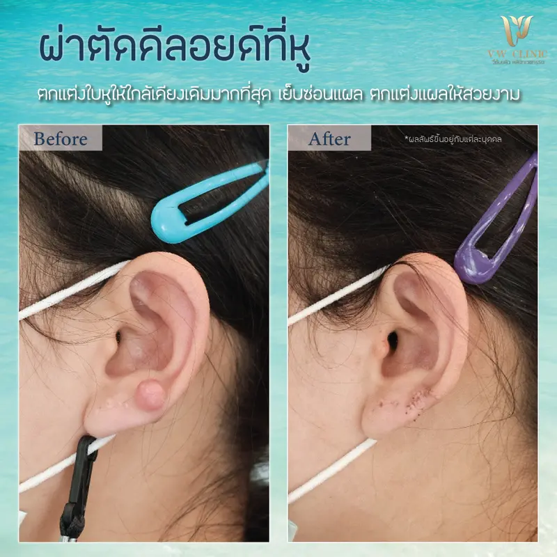 ผ่าตัดคีลอยด์หู