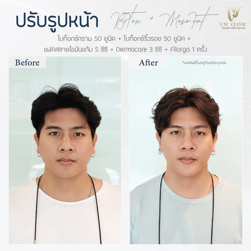 Botox กราม