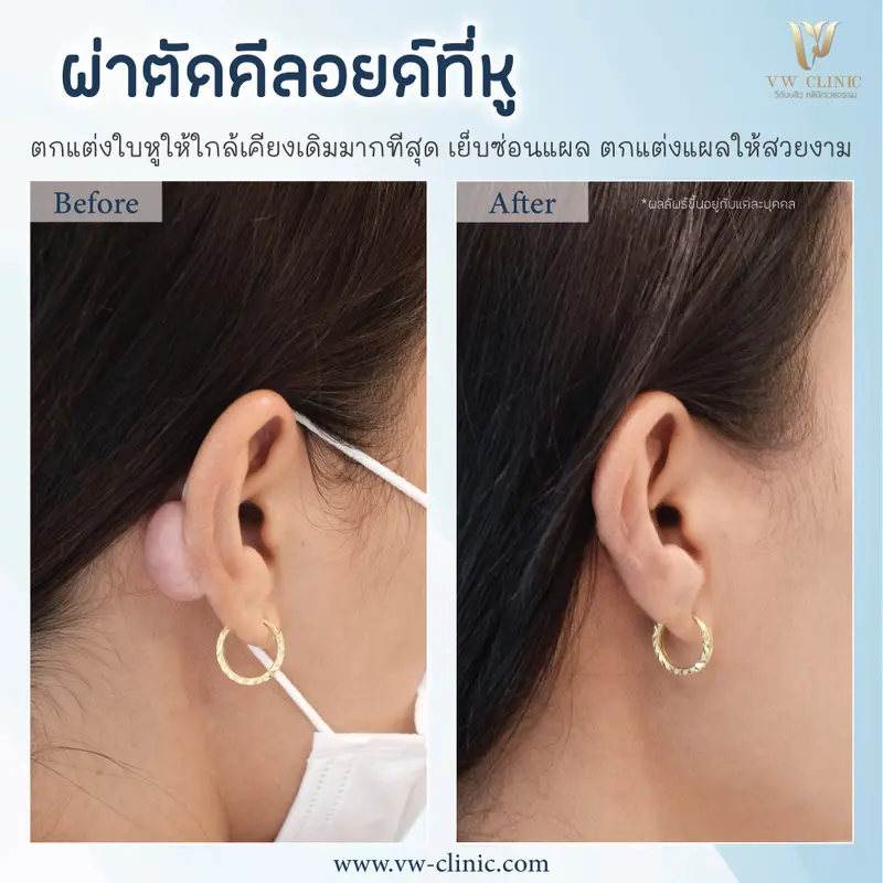 ผ่าตัดคีลอยด์หู