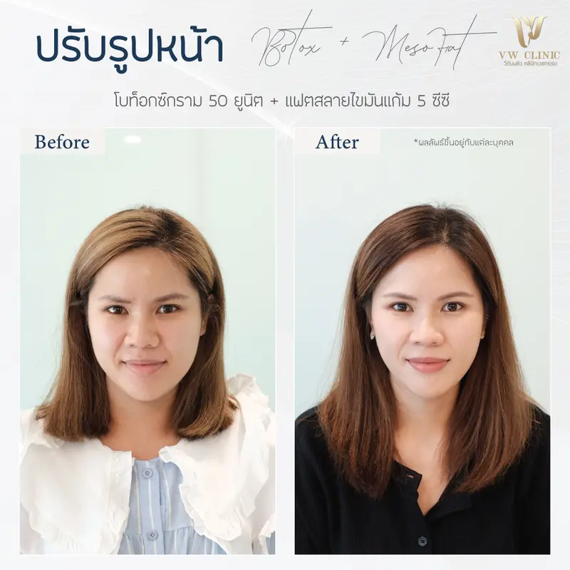 Botox กราม 50 unit + Fat แก้ม 5 cc