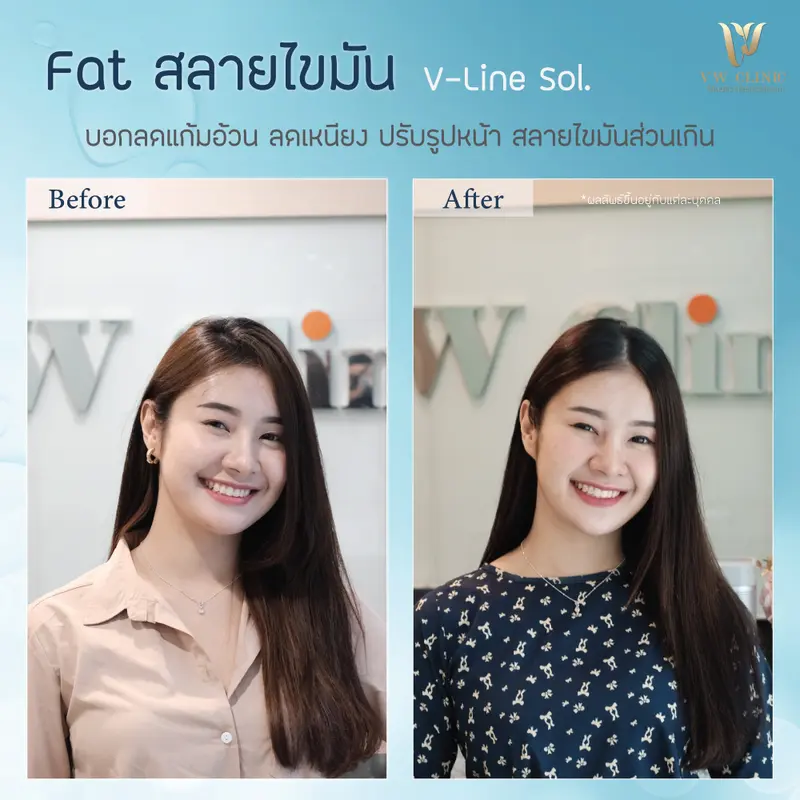 Fat สลายแก้มเหนียง
