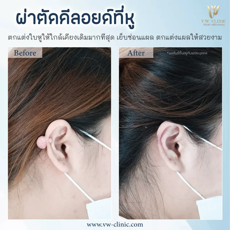 ผ่าตัดคีลอยด์หู