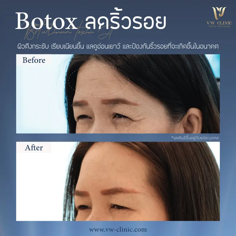 Botox ริ้วรอย 50 unit