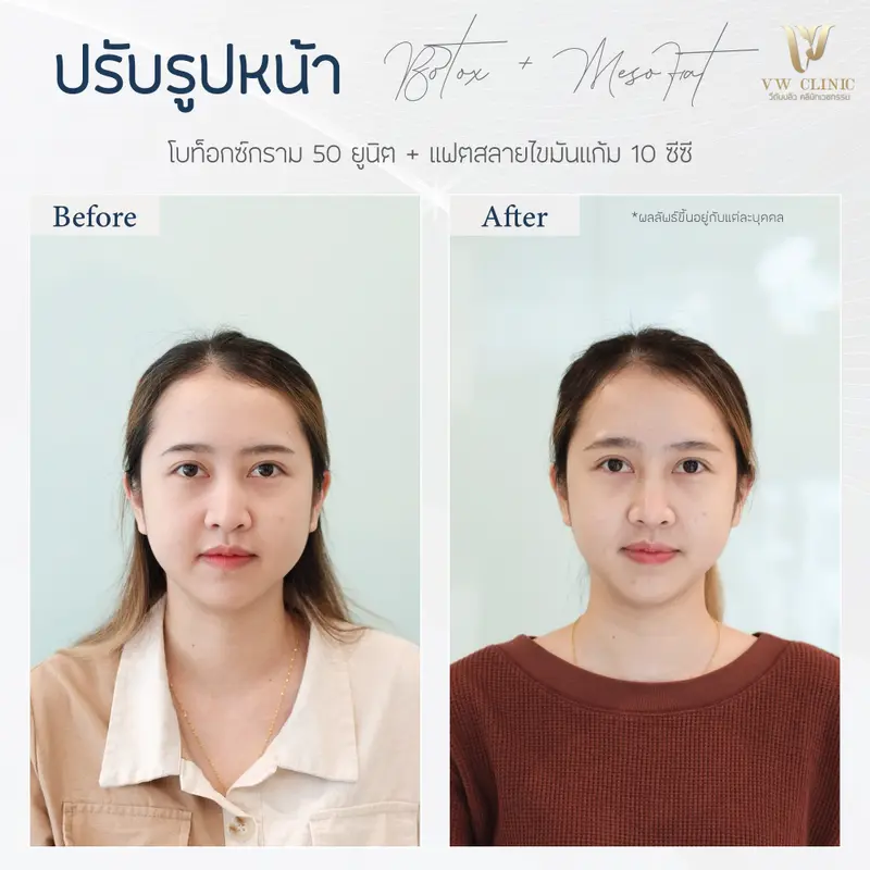 Botox กราม 50 unit + Fat แก้ม 10 cc