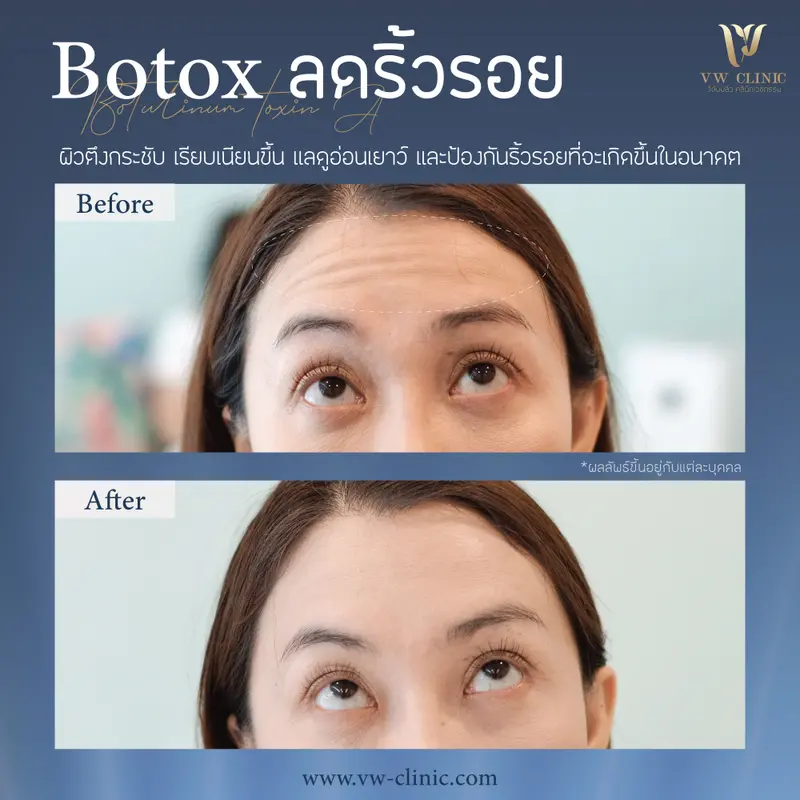 Botox ริ้วรอย 50 unit