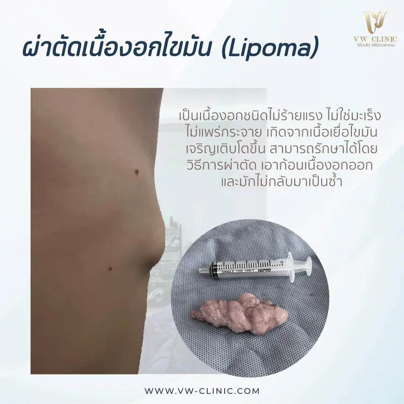 ผ่าตัดเนื้องอกไขมัน