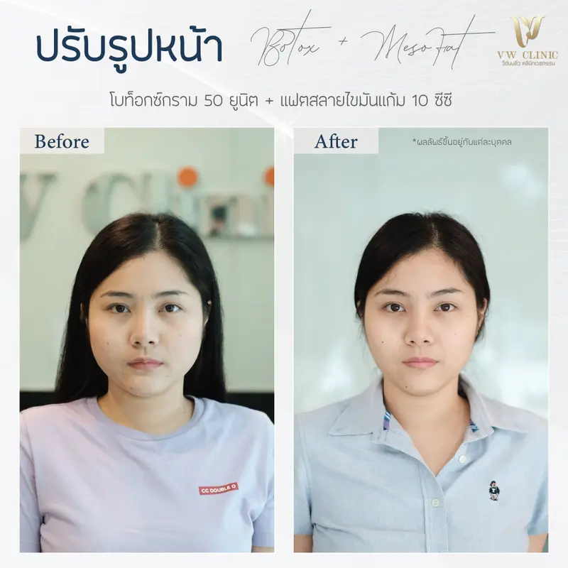 Botox กราม 50 unit + Fat 10 cc แก้ม
