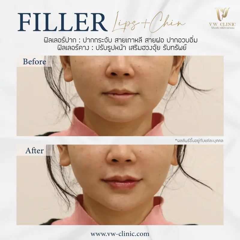 Filler Restylane Kysse 1 cc