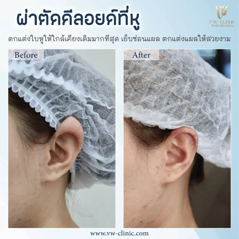 ผ่าตัดคีลอยด์