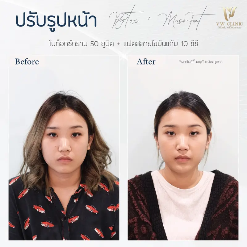 Botox กราม + Fat 10 cc แก้ม