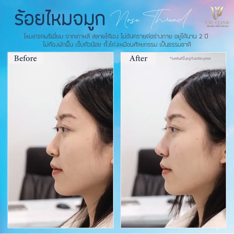 ร้อยไหมจมูก