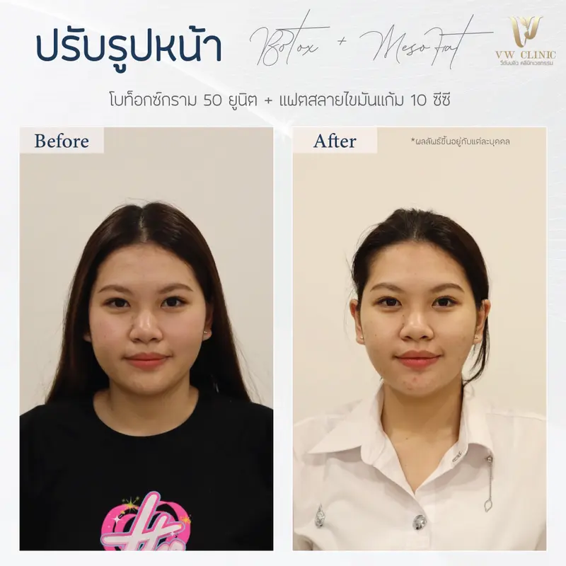 Botox กราม + Fat 10cc แก้ม