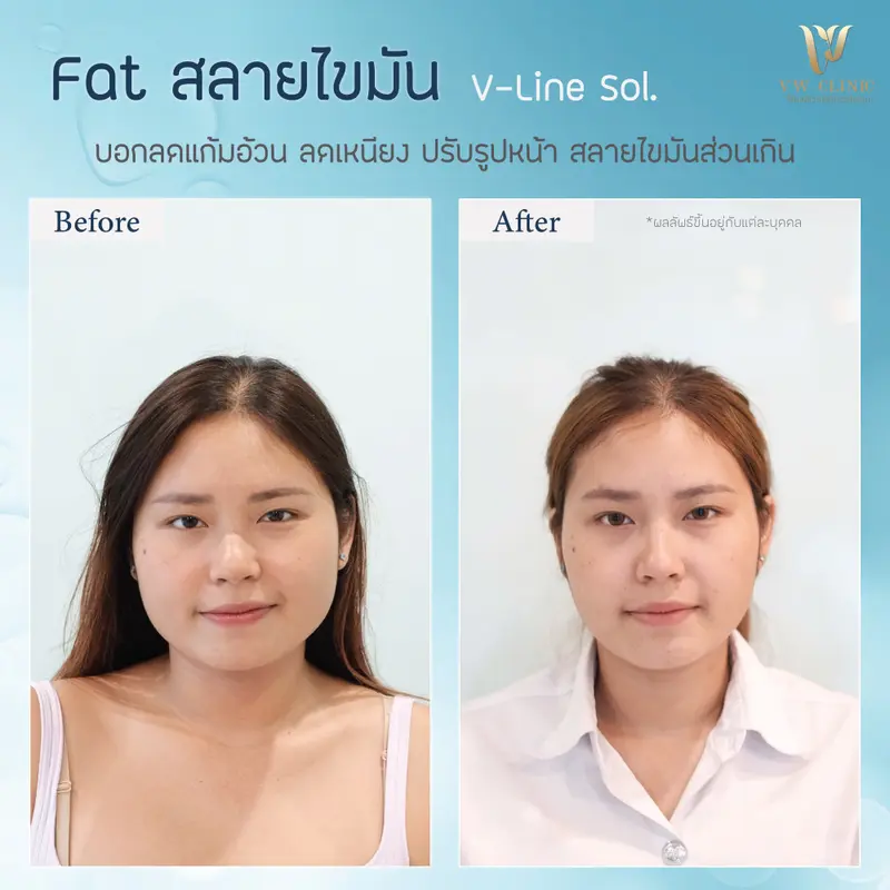 Fat แก้มเหนียง