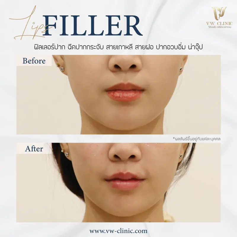 Filler ปาก