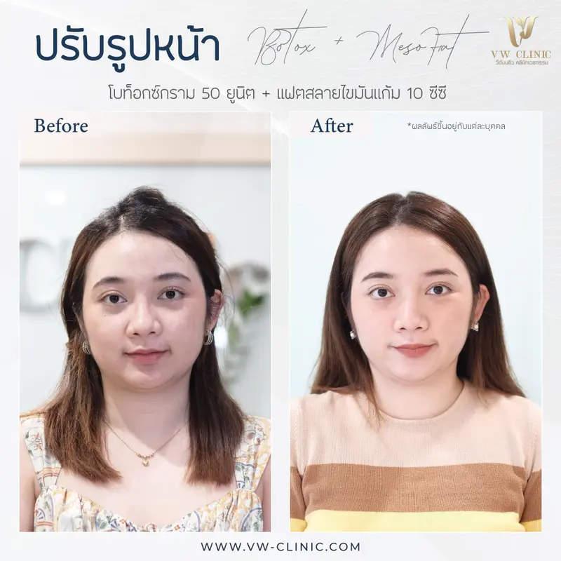 Botox กราม + Fat สลายไขมันแก้ม