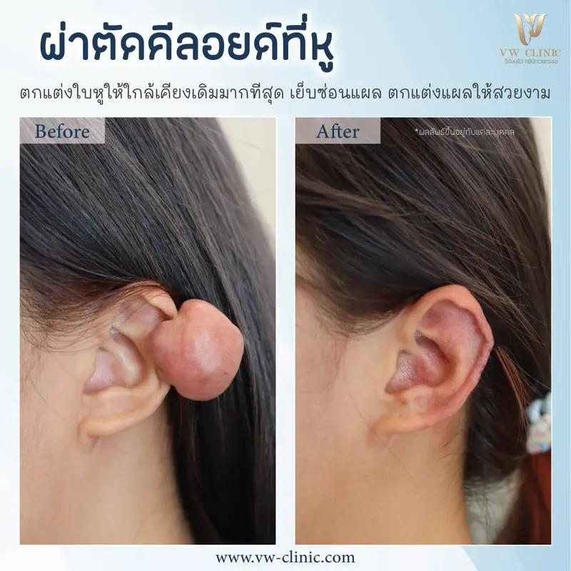 ผ่าตัดคีลอยด์หู