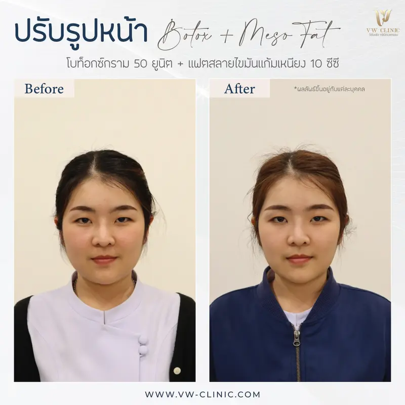 Botox 50 unit + Fat 10 cc