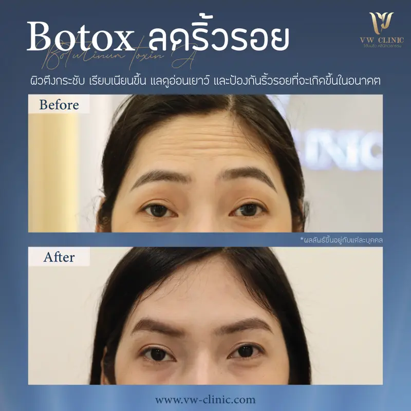 Botox ริ้วรอย 50 unit