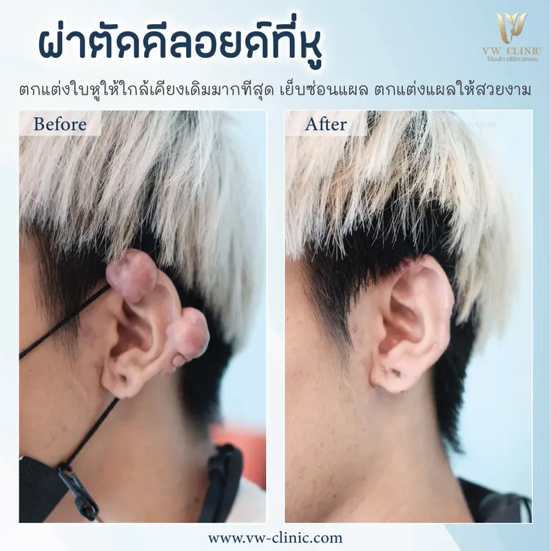 ผ่าตัดคีลอยด์หู