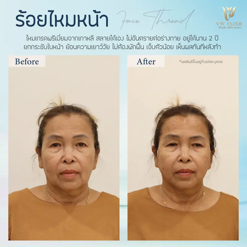 ร้อยไหมหน้า 6 เส้น