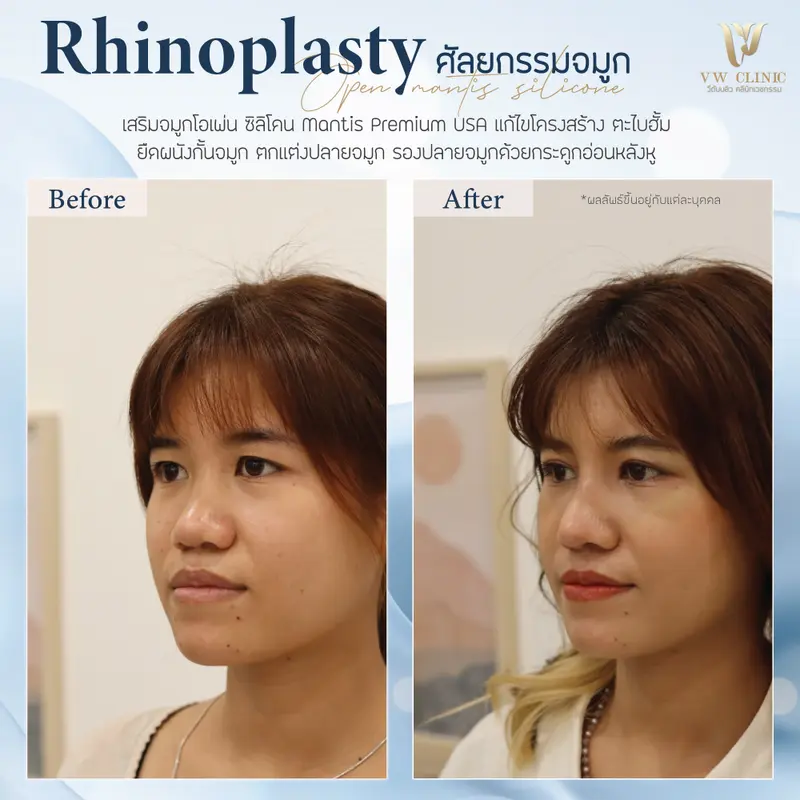 เสริมจมูกใหม่ เทคนิคโอเพ่น