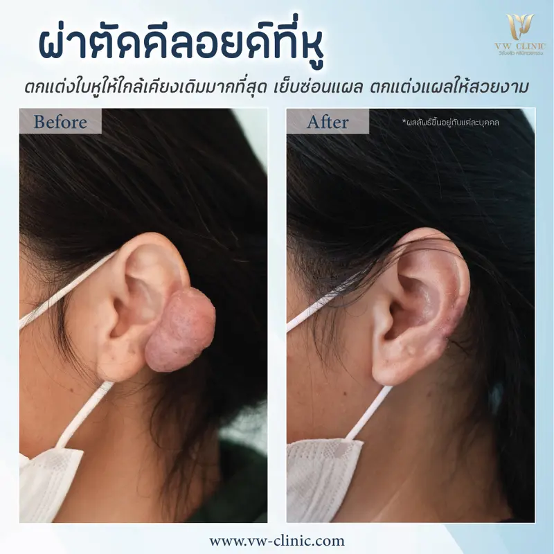ผ่าตัดคีลอยด์หู