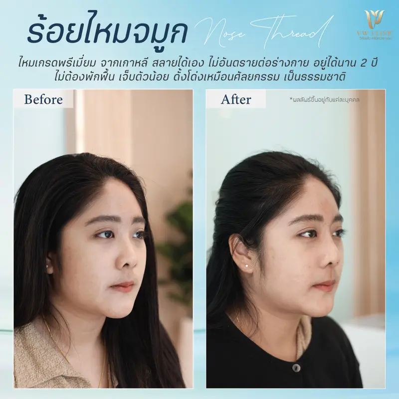 ร้อยไหมจมูก