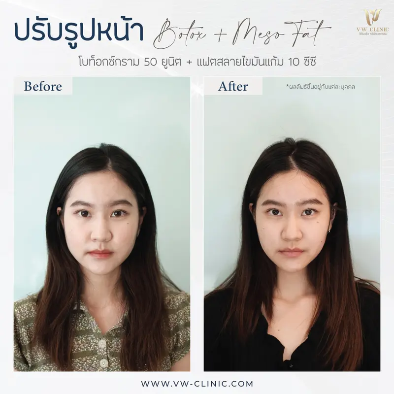 Botox กราม + Fat 10 cc แก้ม