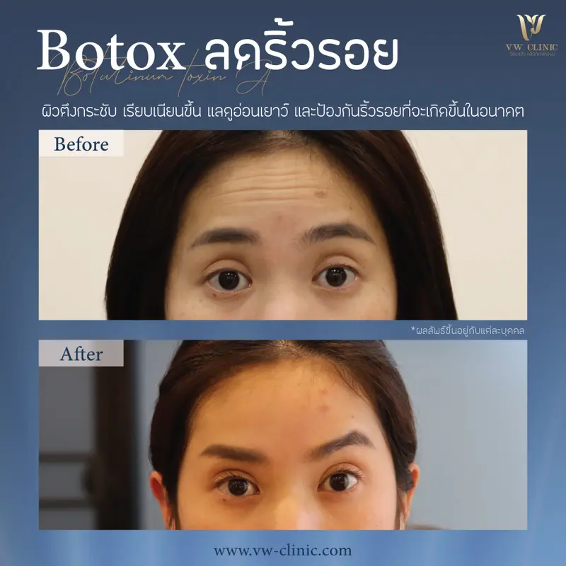 Botox ริ้วรอย 50 unit