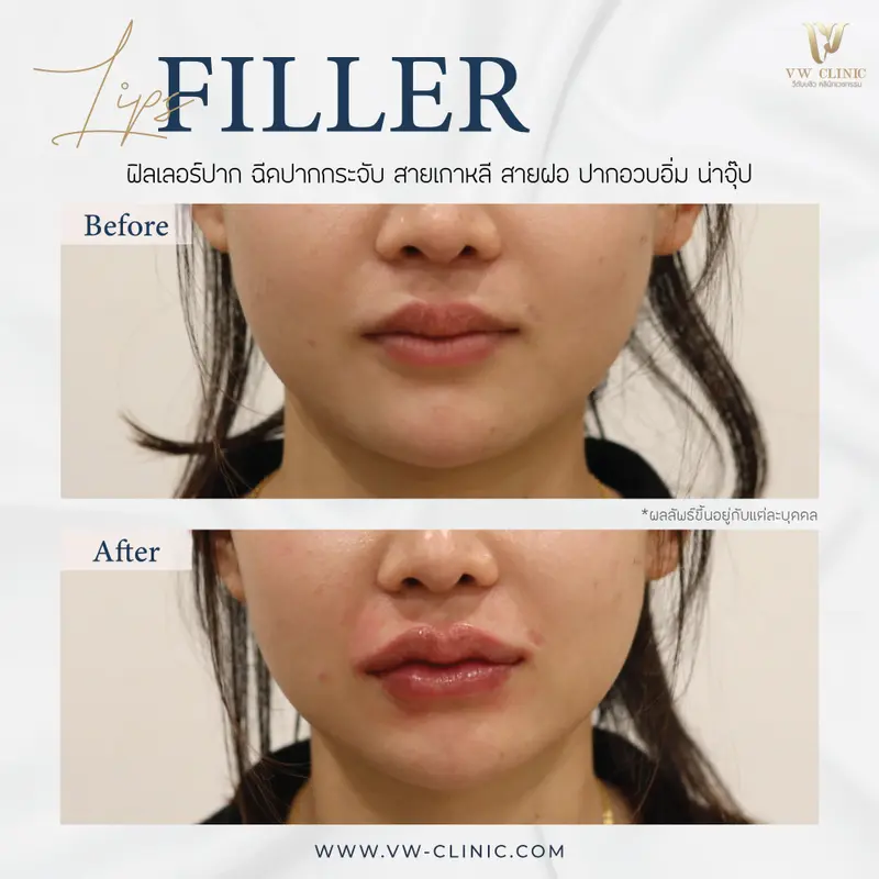 Filler ปาก