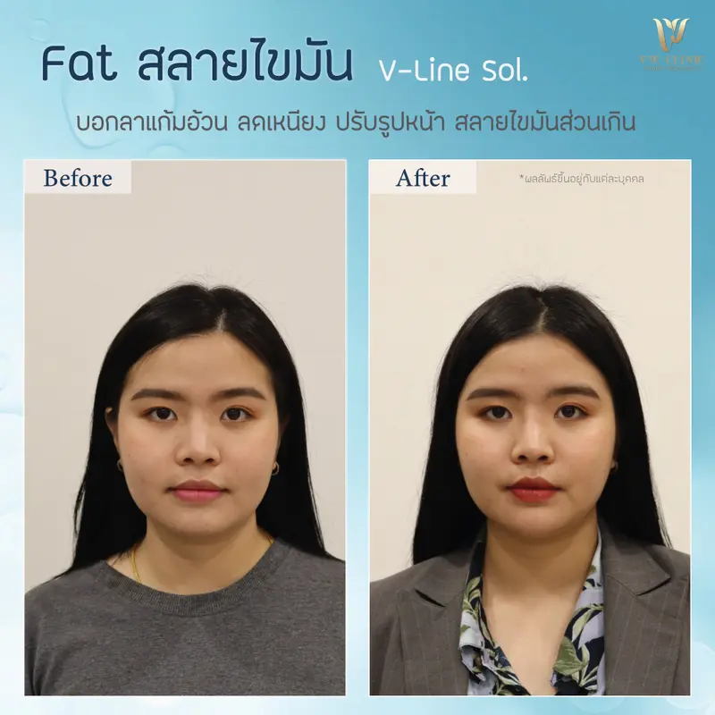 Fat 10 cc แก้ม